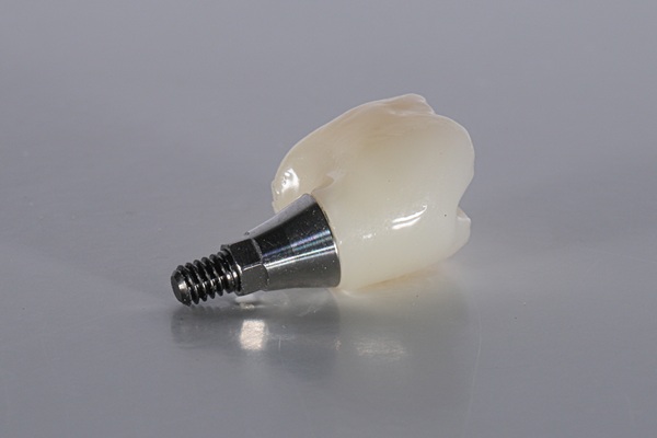 Complete Your Smile With An Implant Crown