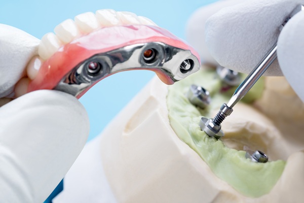 Major Benefits Of Implant Supported Dentures Over Traditional Options