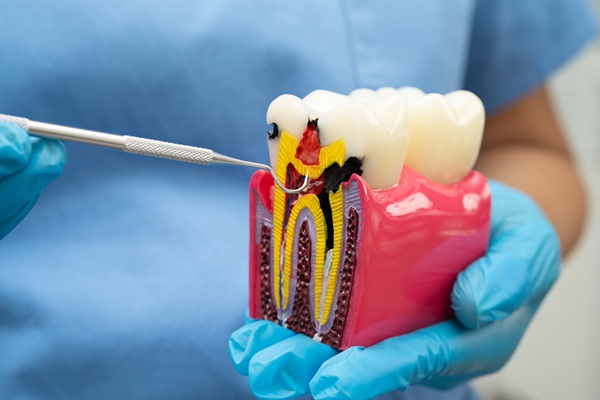 Common Reasons For Root Canal Therapy